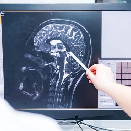 Brain Injury lawyers Traumatic Brain Injuries