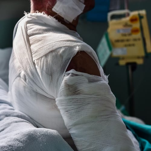 burn injury lawyers - Burn Injuries