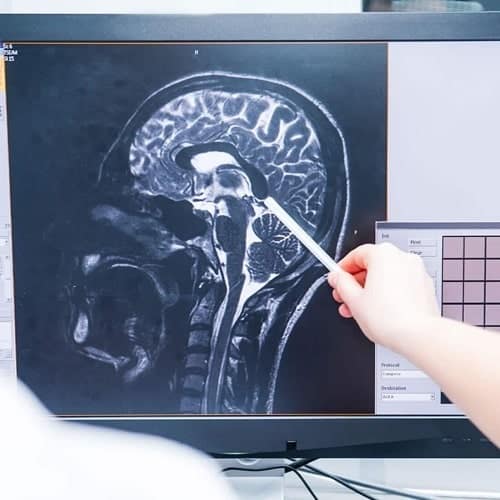 Abogados de lesiones cerebrales Lesiones cerebrales traumáticas. abogados de Lesiones cerebrales traumáticas en san marcos